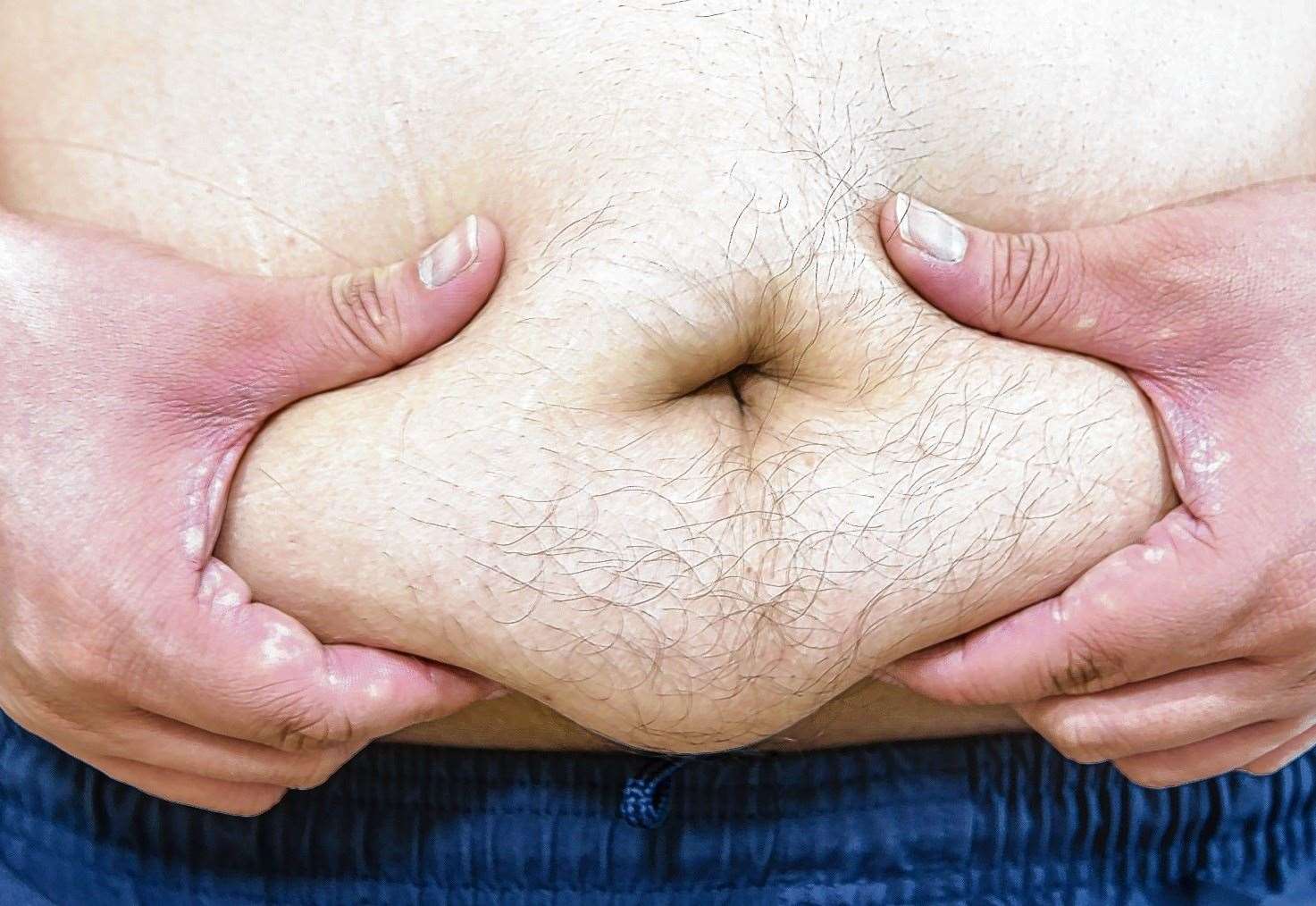 Obesity is on the rise in Kent. Stock image
