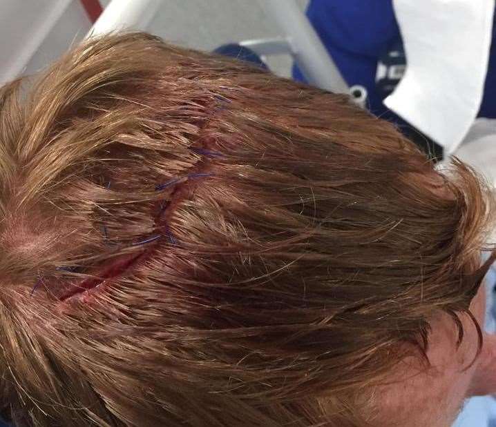 Gash on Jordan's head following accident on castle slide at Beachfields, Sheerness