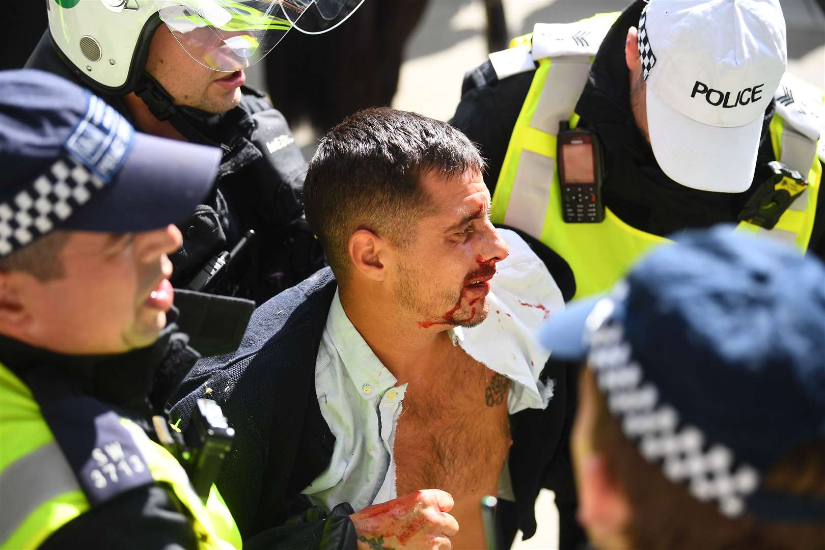 A demonstrator with a facial injury in London’s Trafalgar Square (Victoria Jones/PA)