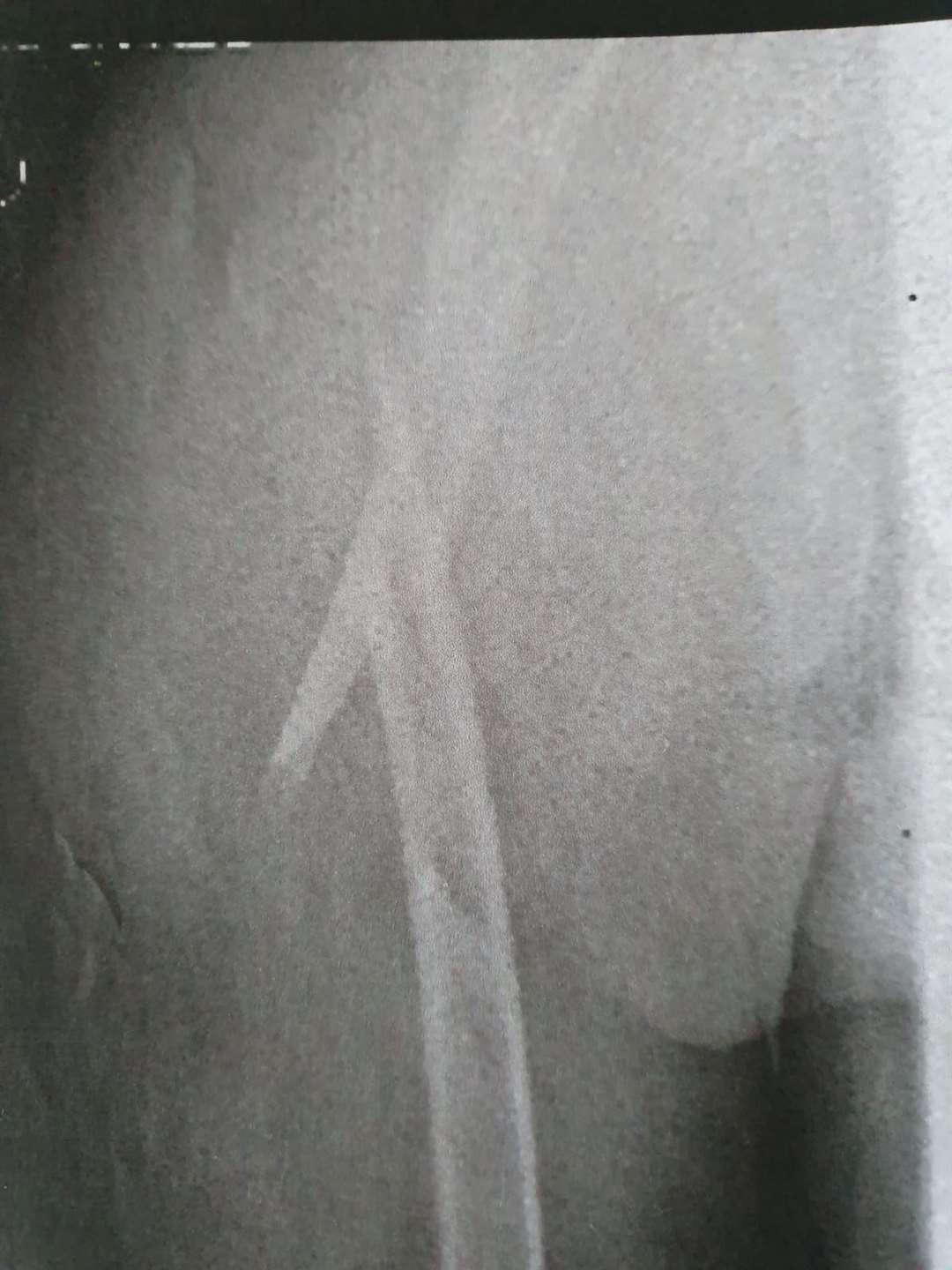 An X-ray of the fracture sustained by Matthew Bates at a Sussex care home (Family handout/PA)