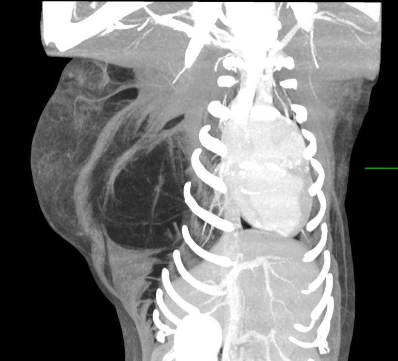 The tumour, to the left of her ribcage, had been steadily growing throughout her life. Picture: North Downs Specialist Referrals