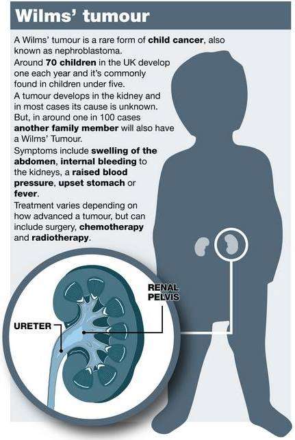 Wilms' tumour facts