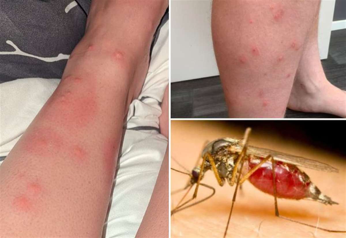 Ankle-biter mosquitoes are on the attack in SoCal. Here are tips