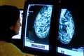 UK could experience up to 35,000 excess cancer-related deaths due to Covid-19