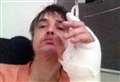 Pete Doherty hospitalised after hedgehog injury