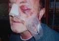 Attack leaves cabbie blind in one eye