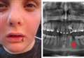 Student receives £20k payout after wrong tooth extracted