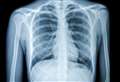 Warning over rise in tuberculosis cases as efforts to eliminate it ‘stall’