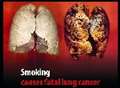 Gruesome graphics to stop smokers