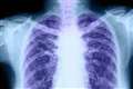 CT scanning detects early signs of lung cancer in 70% of cases – study