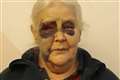 Abhorrent attack on pensioner with leukaemia leaves her badly bruised