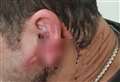 Lorry driver's earlobe hangs off after attack