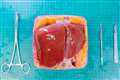 3D printed liver model created to help surgeons prepare for difficult operations