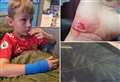 Mum’s warning after son’s hand sliced on cracked iPad