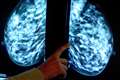 1,500 women missed out on annual checks despite ‘very high’ breast cancer risk