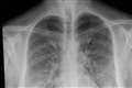 Lung disease deaths highest in western Europe, charity warns in call for action