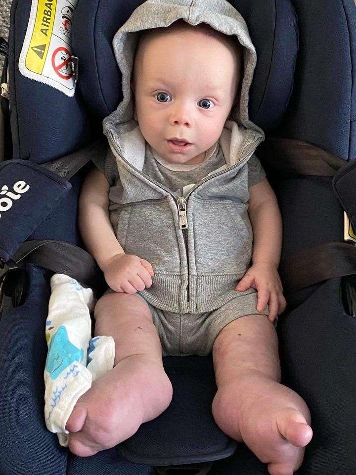 Brodie Arbon-Davis was born with a rare genetic defect that causes his legs to swell up. Picture: SWNS