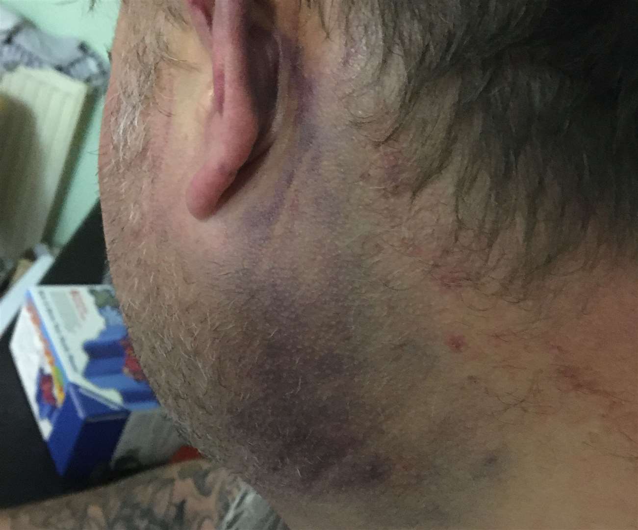 Bruising to Mr Herbert's neck