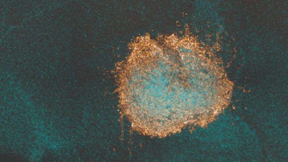 Diffuse midline glioma cells (Elisa Izquierdo/ICR)