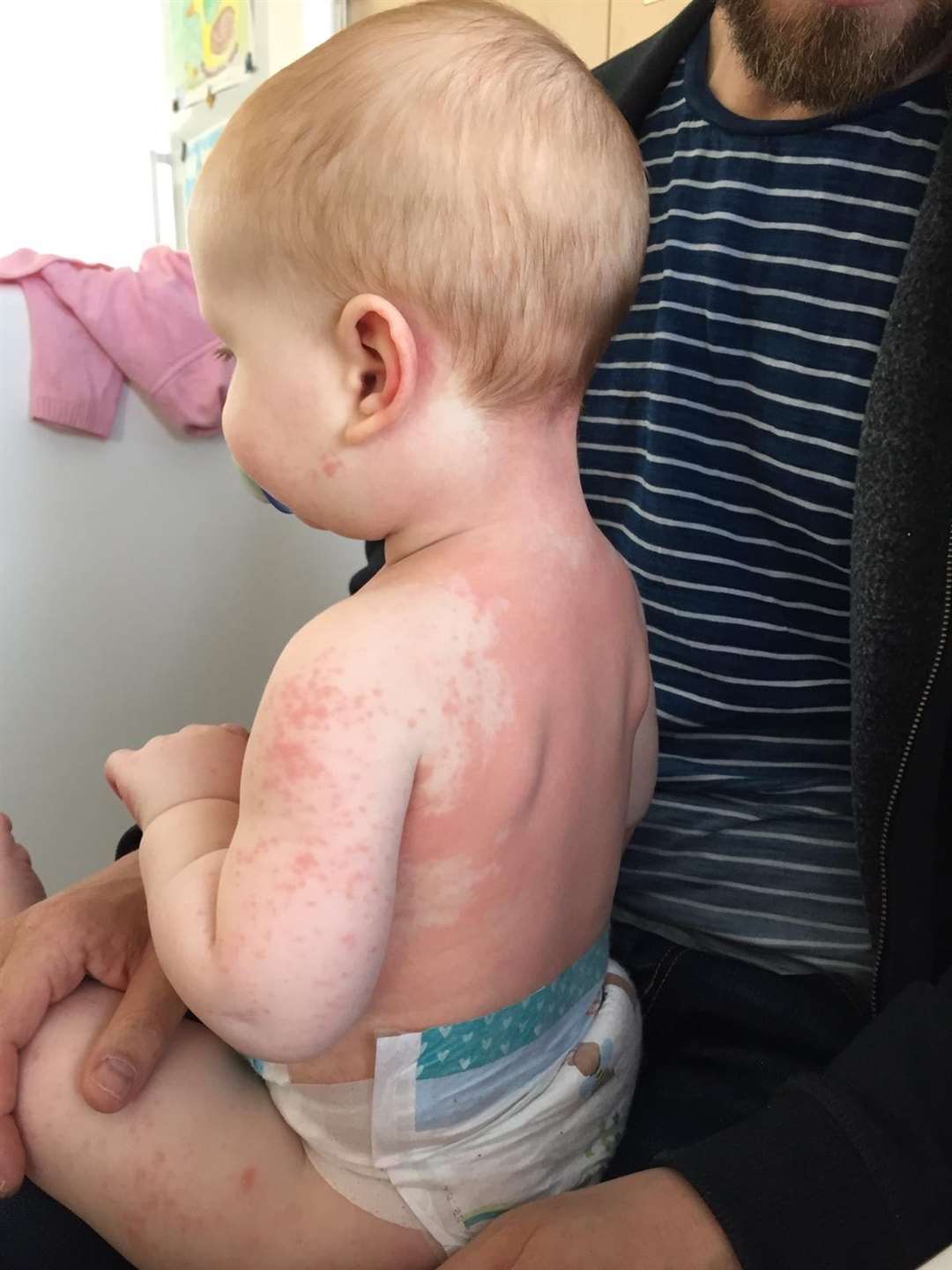 Alexander developed a rash across his back, which spread to the rest of his body (Family handout/PA)