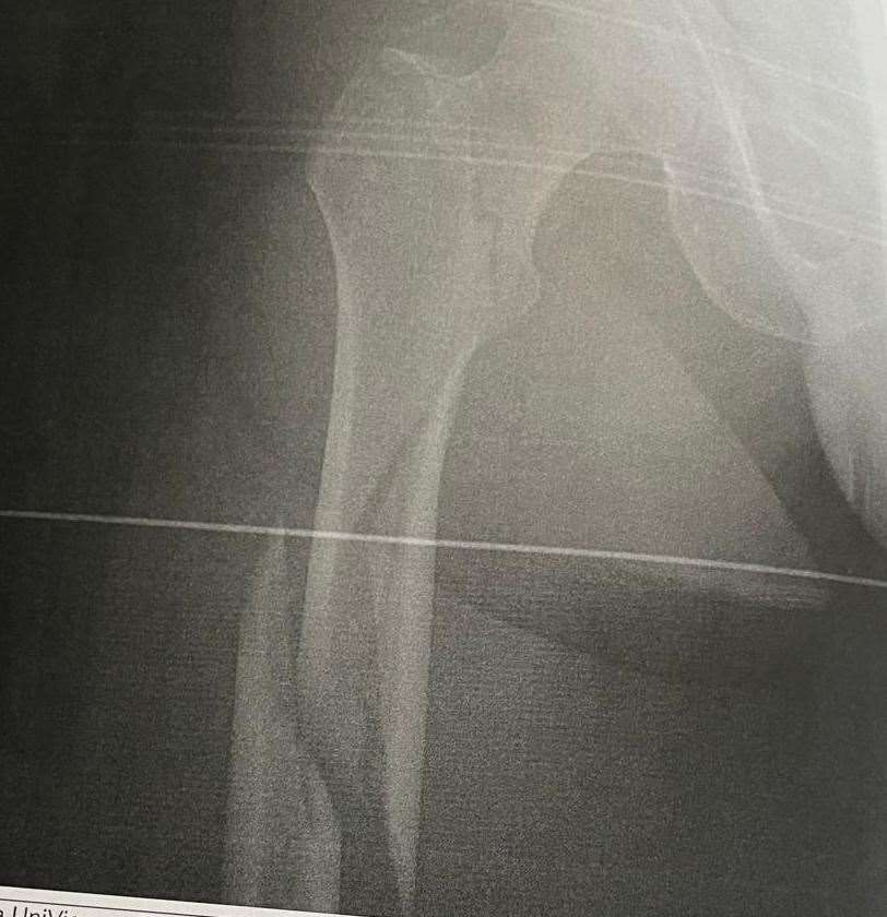 An x-ray image shows the extent of Morgan De-Holland's injury after he crashed his moped in Queenborough