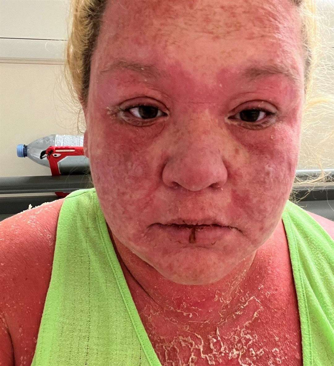 Amy had a huge rash over her whole body after the bite and was treated with antibiotics. Picture: SWNS