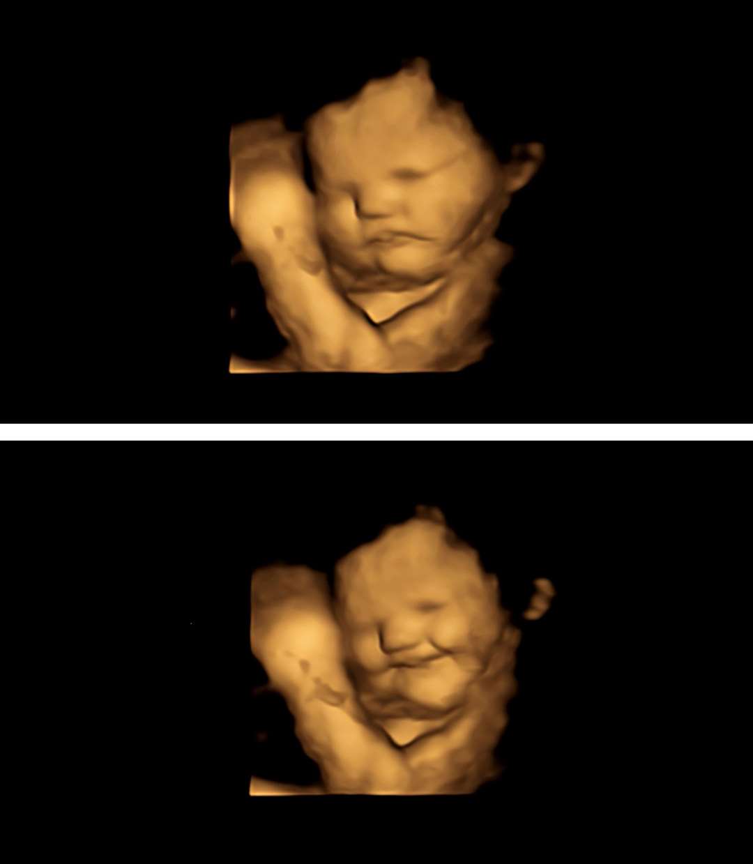 Handout image of a 4D scan of a foetus showing a neutral face (top) and the same foetus showing a laughter-face reaction after being exposed to the carrot flavour (Durham University/PA)