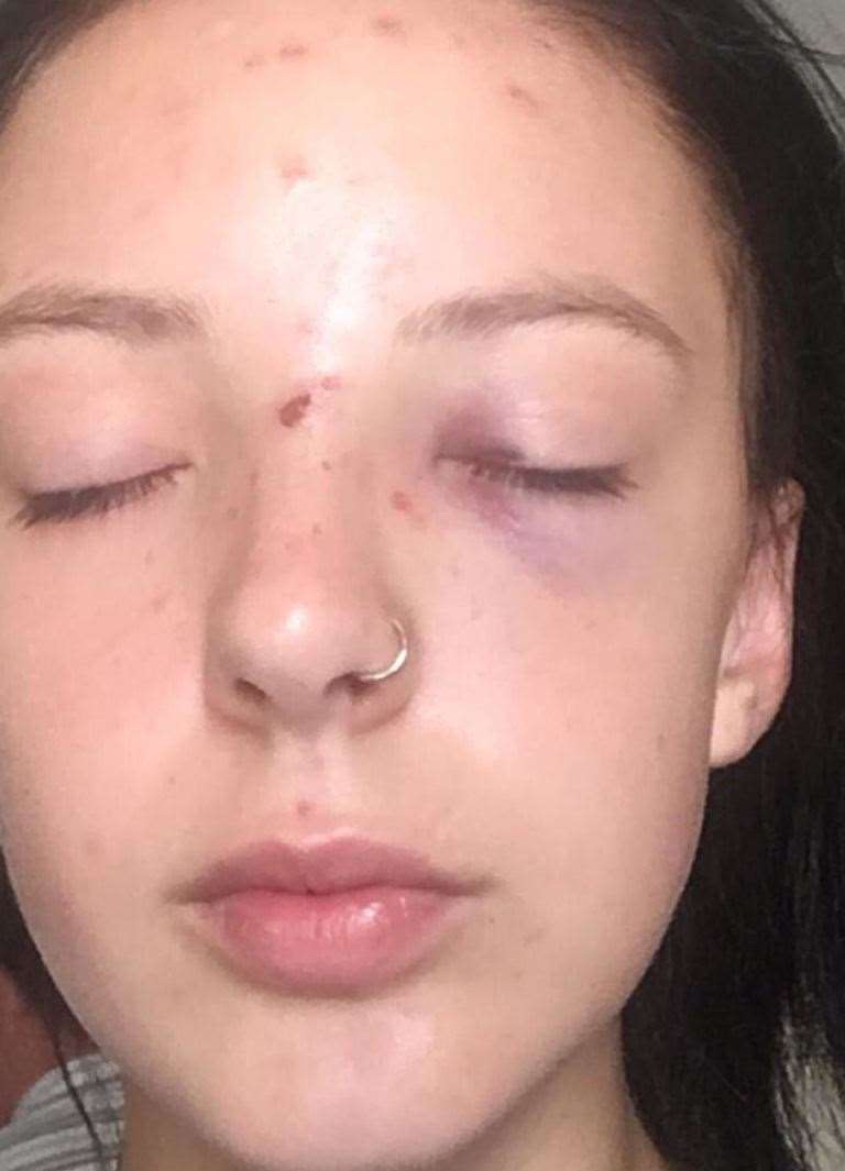 Katie Lambert was left with a black eye after she was punched Picture: Katie Lambert