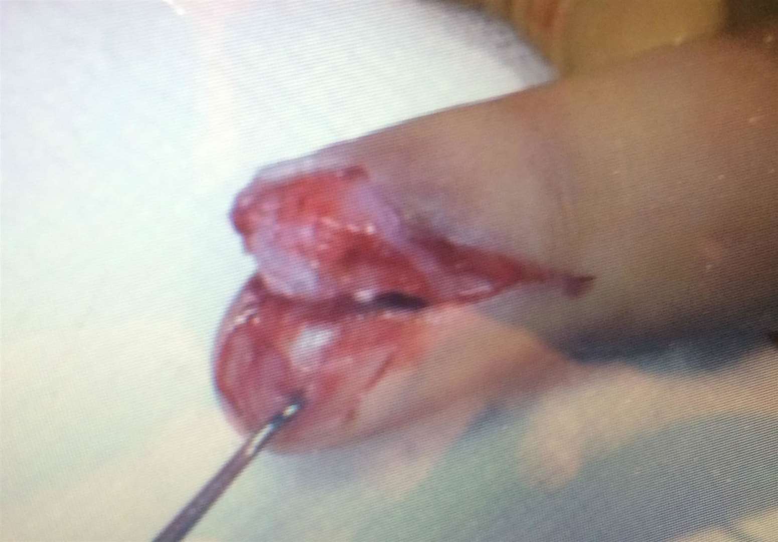 The injured finger