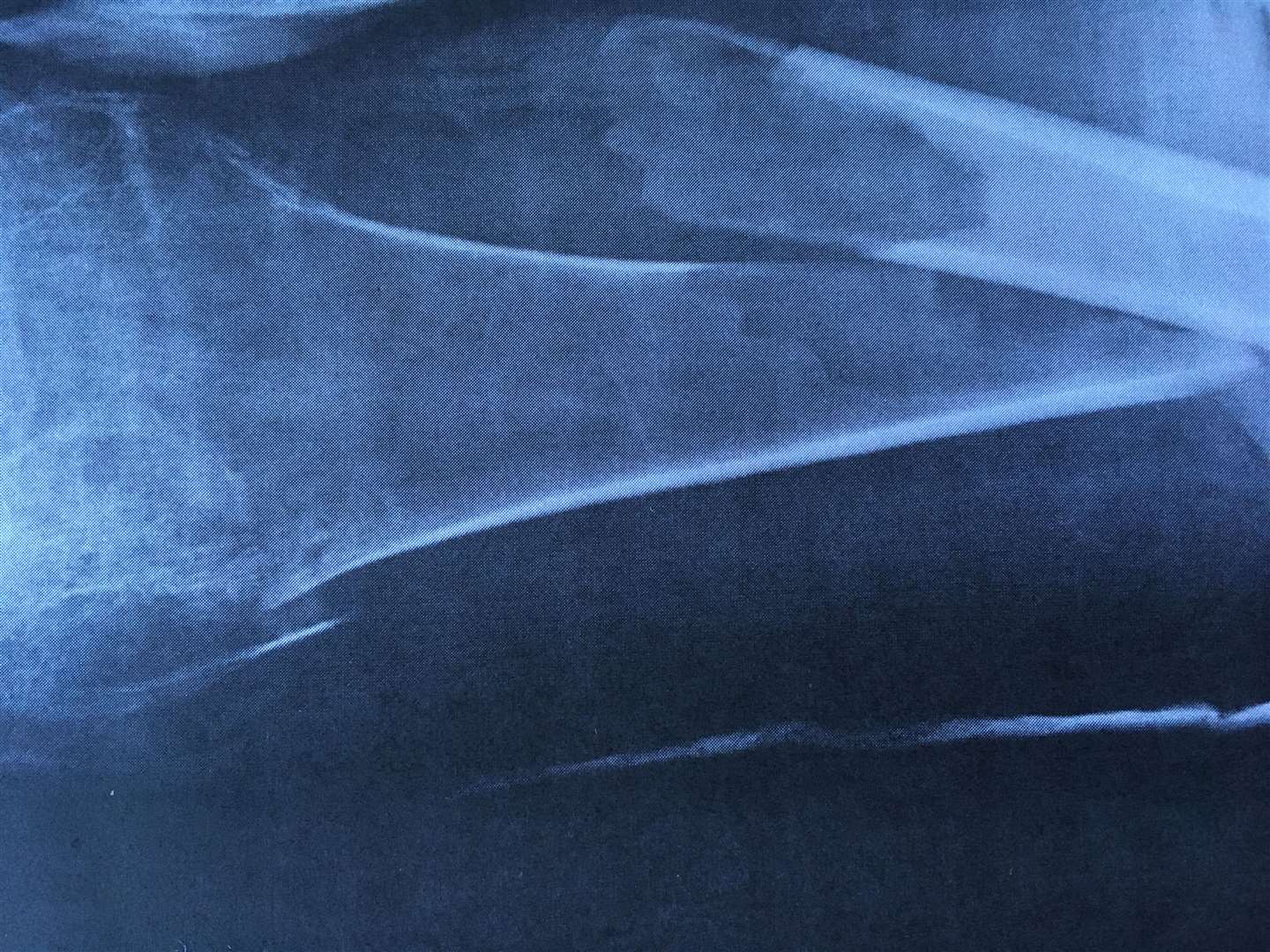 An X-ray of the fracture sustained by Gary Lewis at a Sussex care home (Family handout/PA)