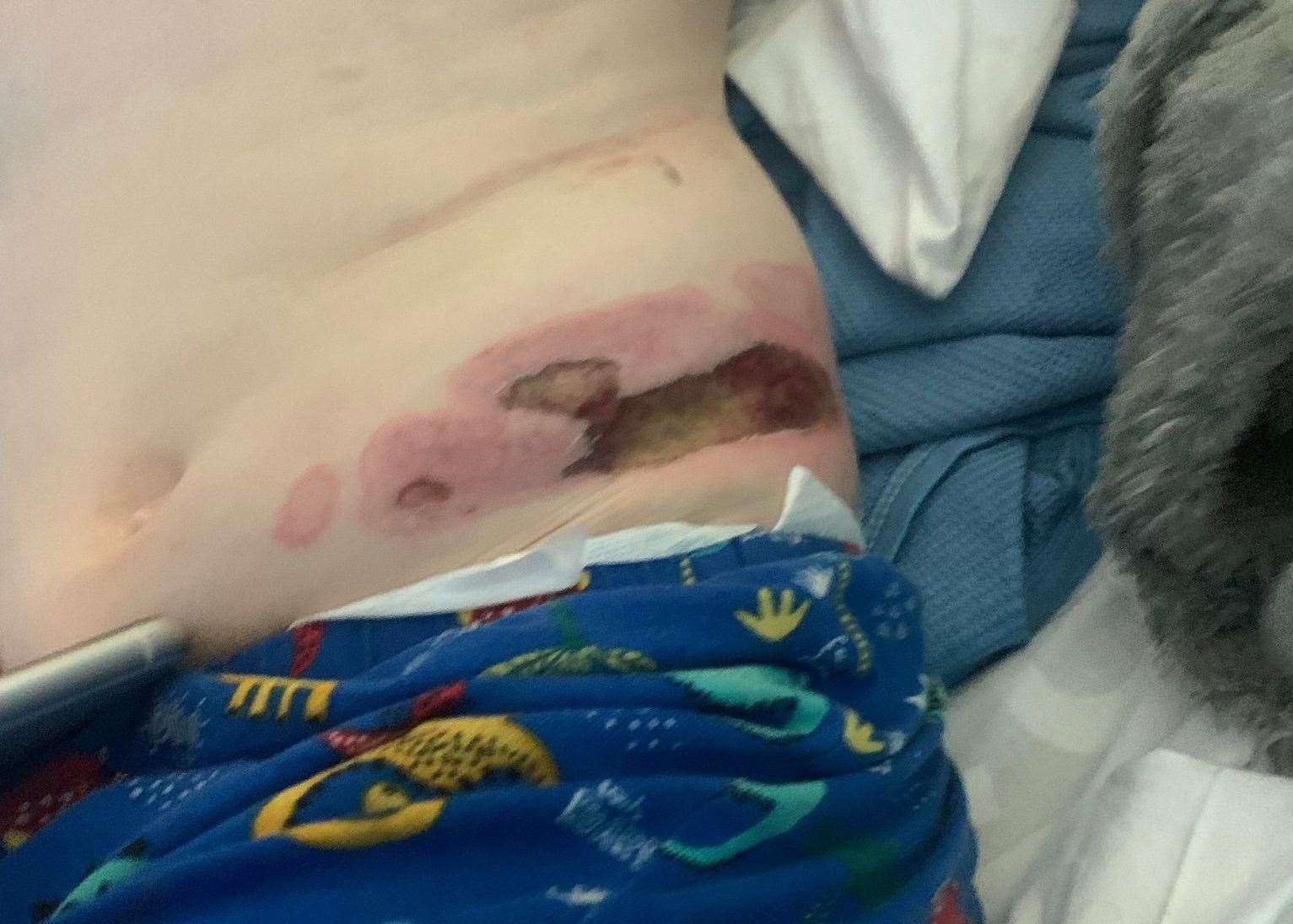 The injuries the four-year-old boy sustained after being hit by a car in Bell Road, Sittingbourne. Picture: Ethan Cording