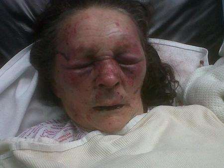 Ann Davis suffered horrific injuries in an assault in Ashford