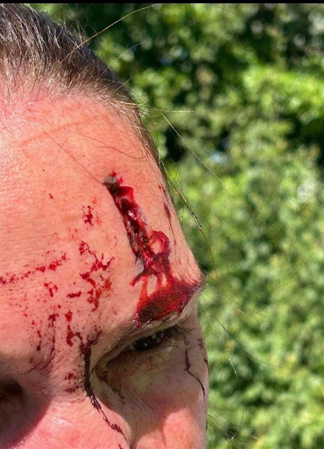 Jessica's mother had a cut to the forehead following the crash on A28 Canterbury Road near Sarre. Photo: Jessica Grant