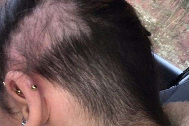 Alopecia areata is a condition which causes big chunks of hair to fall out