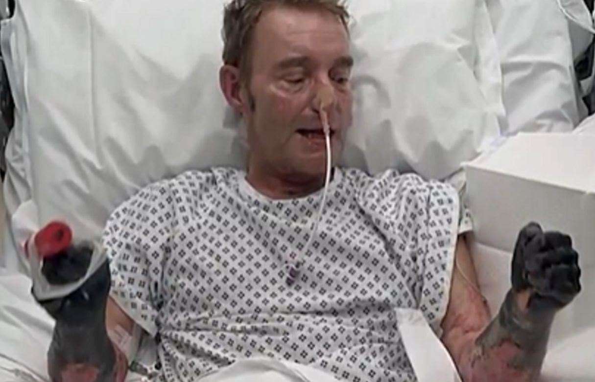 Former MP Craig Mackinlay had to have his arms and legs amputated after a devastating case of sepsisPicture: GB News