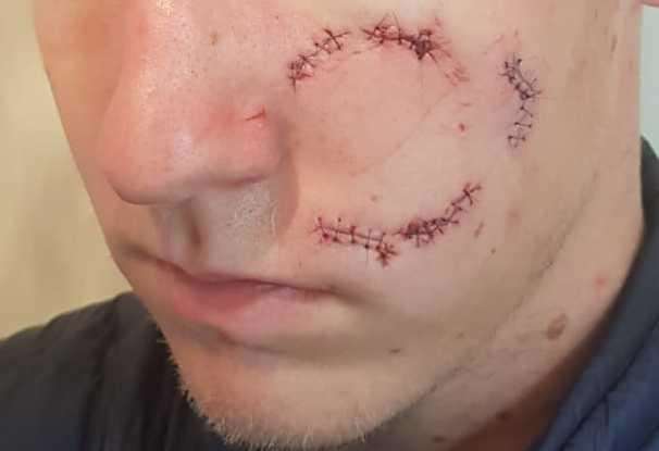 A teenager had a bottle shoved in his face causing this injury
