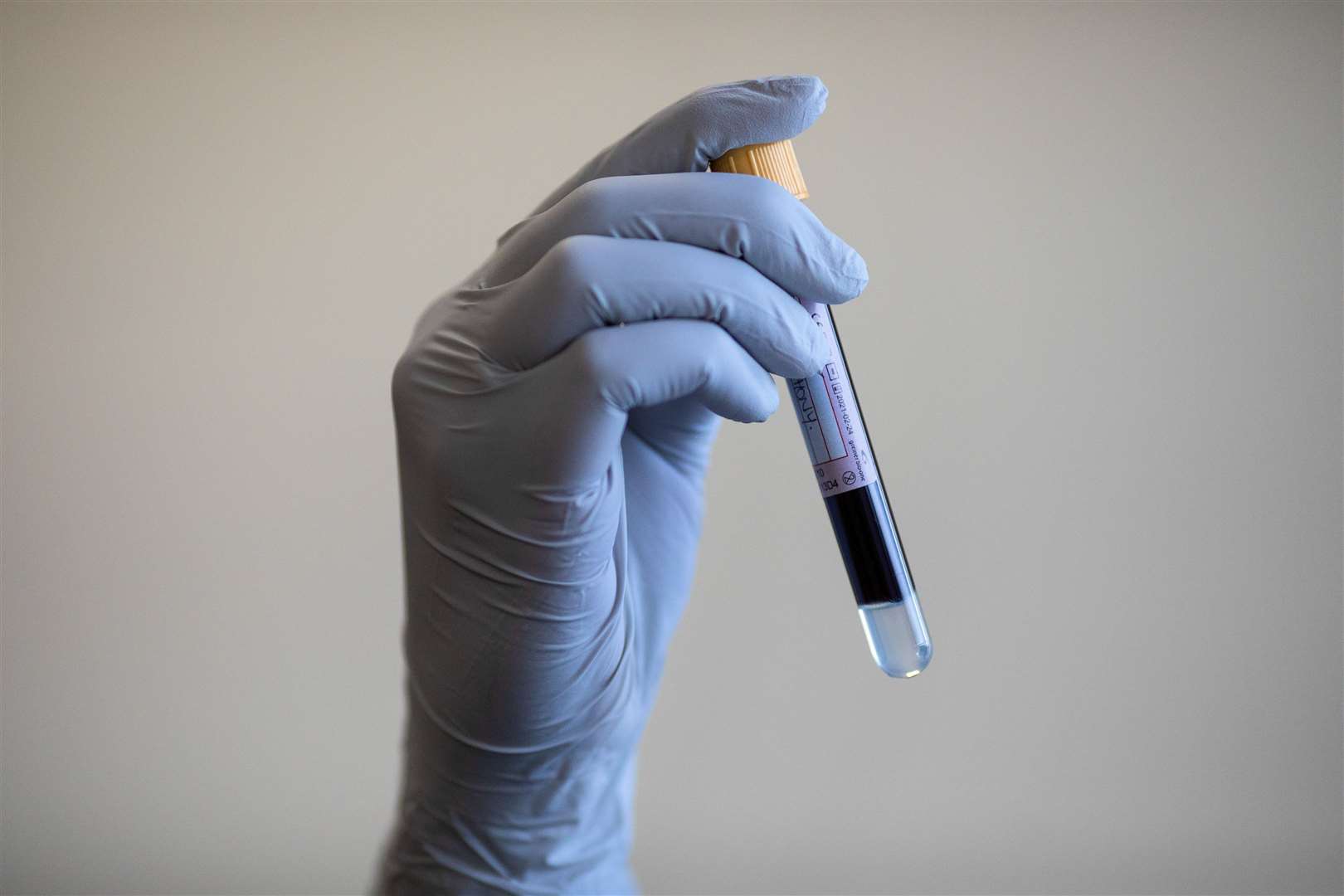 new-blood-test-for-prostate-cancer-is-94-accurate-researchers-say