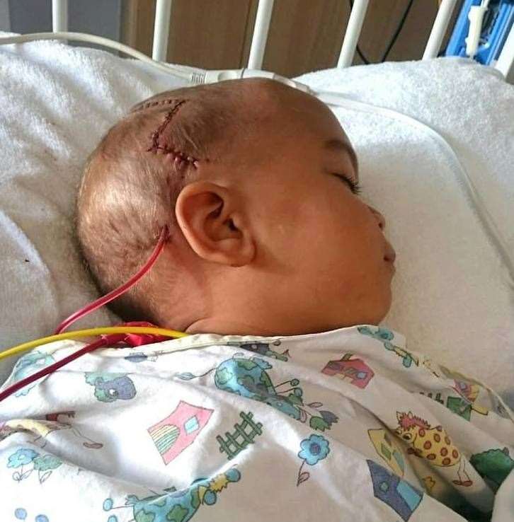 Orion, who had craniosynostosis, had his skull taken apart and put back together. (15321272)