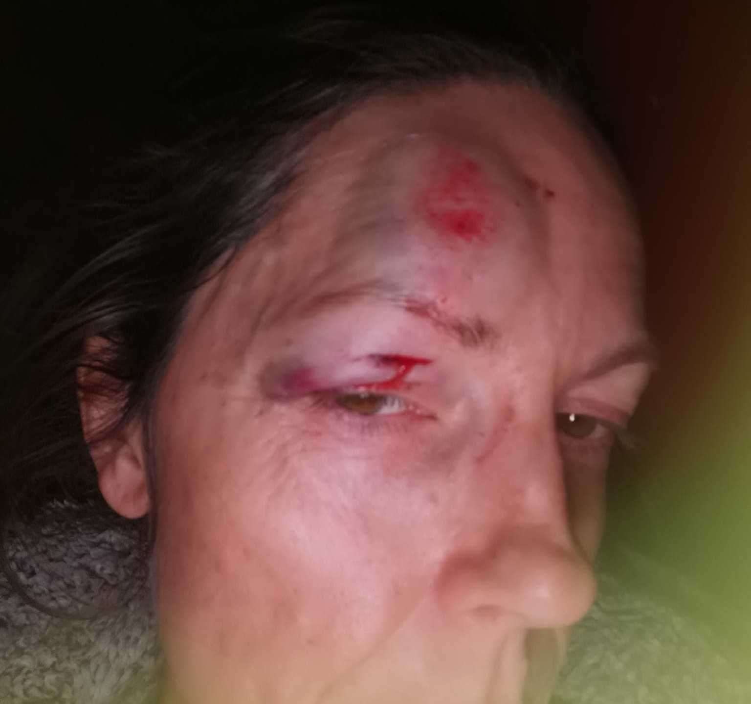 Sue Heath-Hall suffered facial injuries after tripping over fly-tipped rubbish in Cliftonville Avenue, Margate. Picture: Sue Heath-Hall