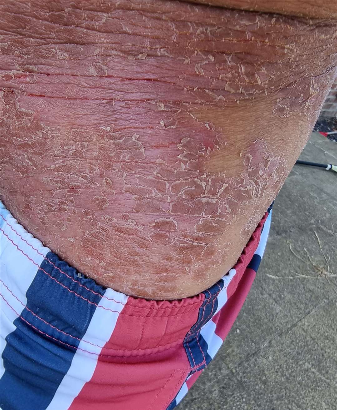 Flaky, itchy skin comes off in layers