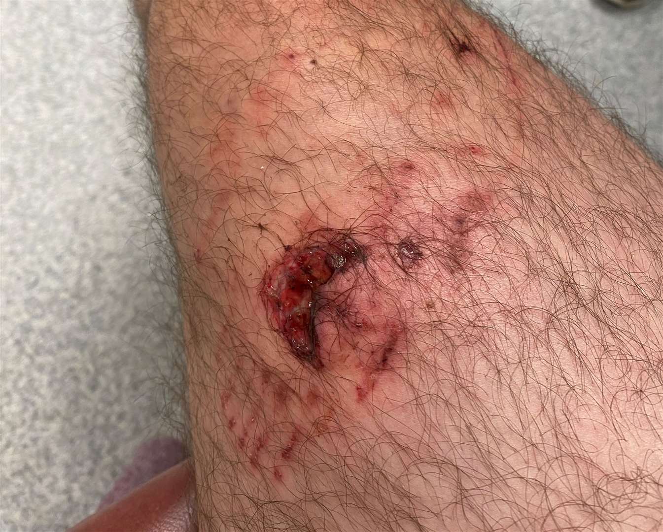 The rottweiler also attacked his legs