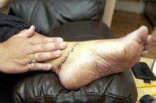 Melanie Miller who cut her foot on a discarded bbq