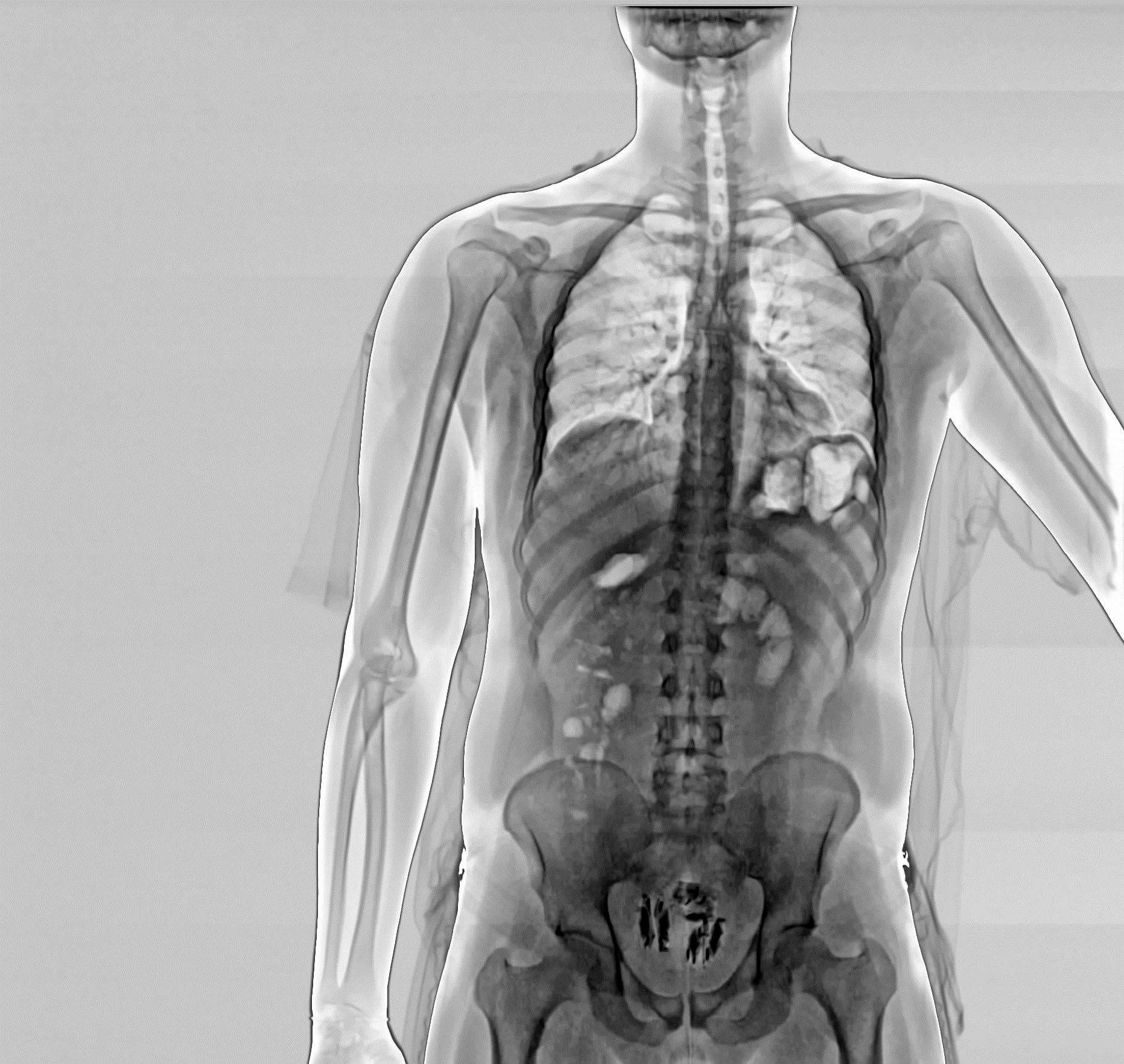 Full Picture Real Human Body X Ray