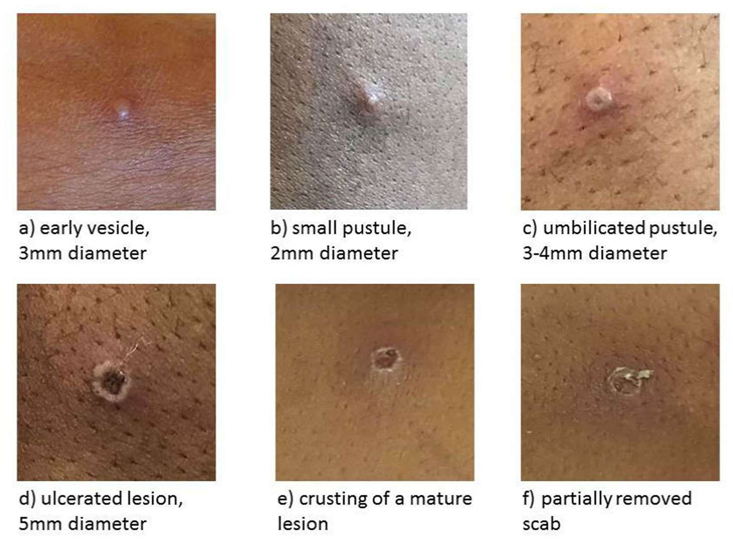 The stages of a monkeypox lesion. Image: UKHSA (58448167)