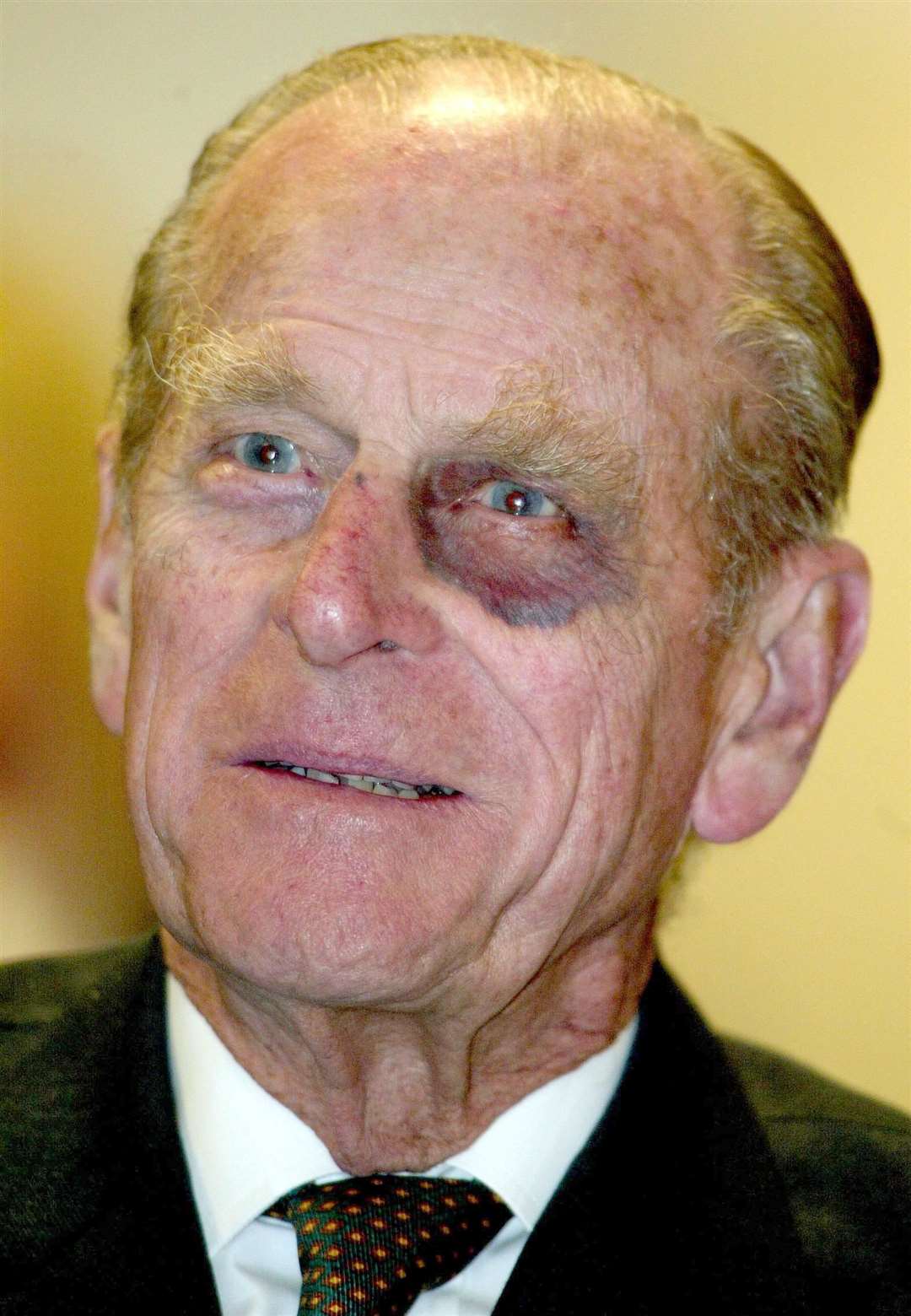 The Duke of Edinburgh sporting a black eye (Chris Ison/PA)