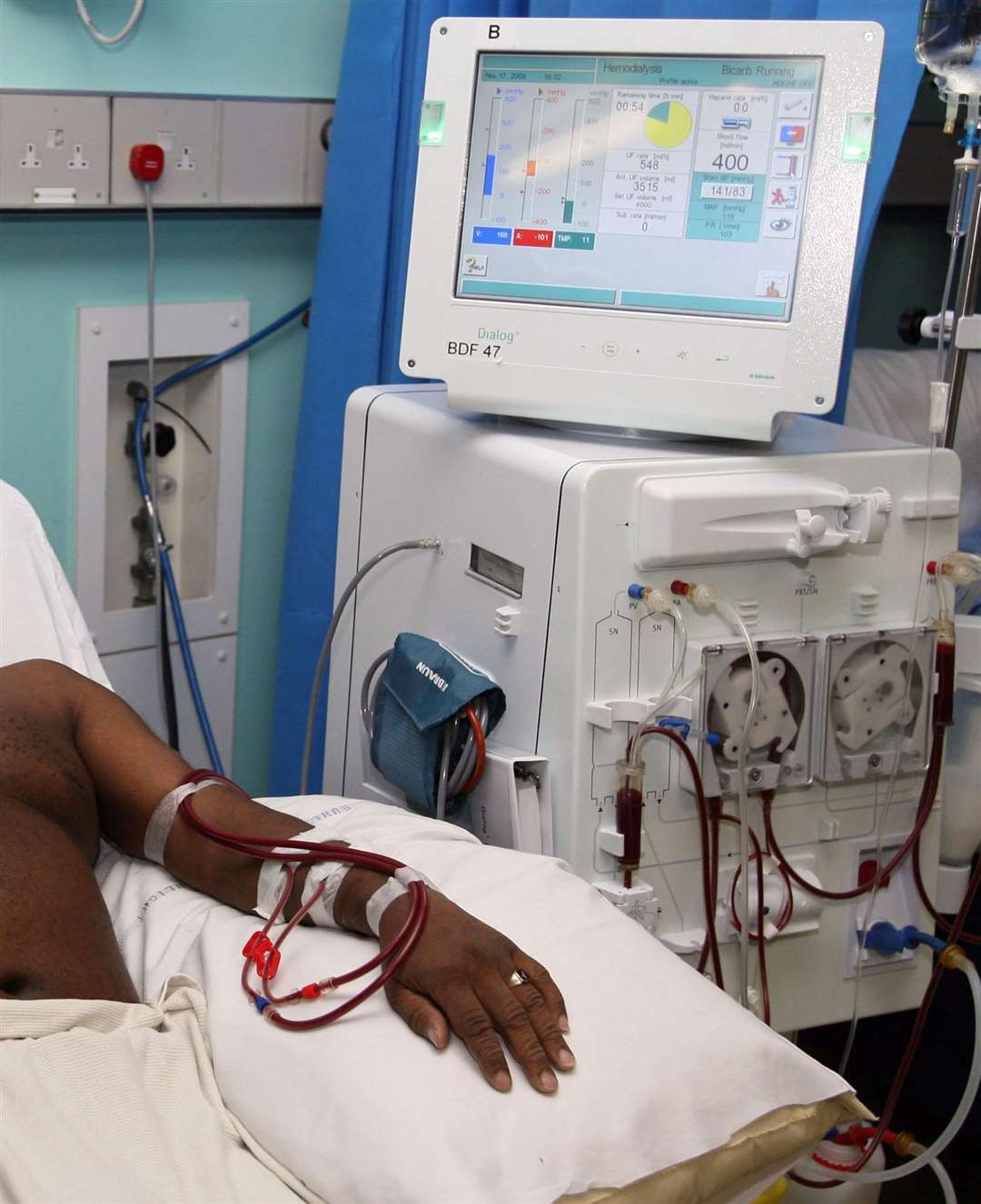 Thousands of people receive dialysis in the UK (Lewis Whyld/PA)