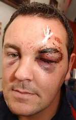 NATHAN PARKS: doctors have warned he may have permanent scarring to his face. Picture: JIM RANTELL