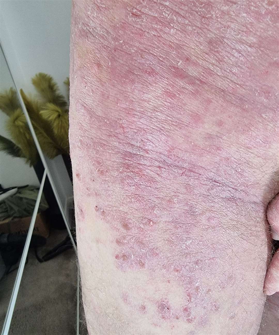 Angry rash has spread over Sam's body