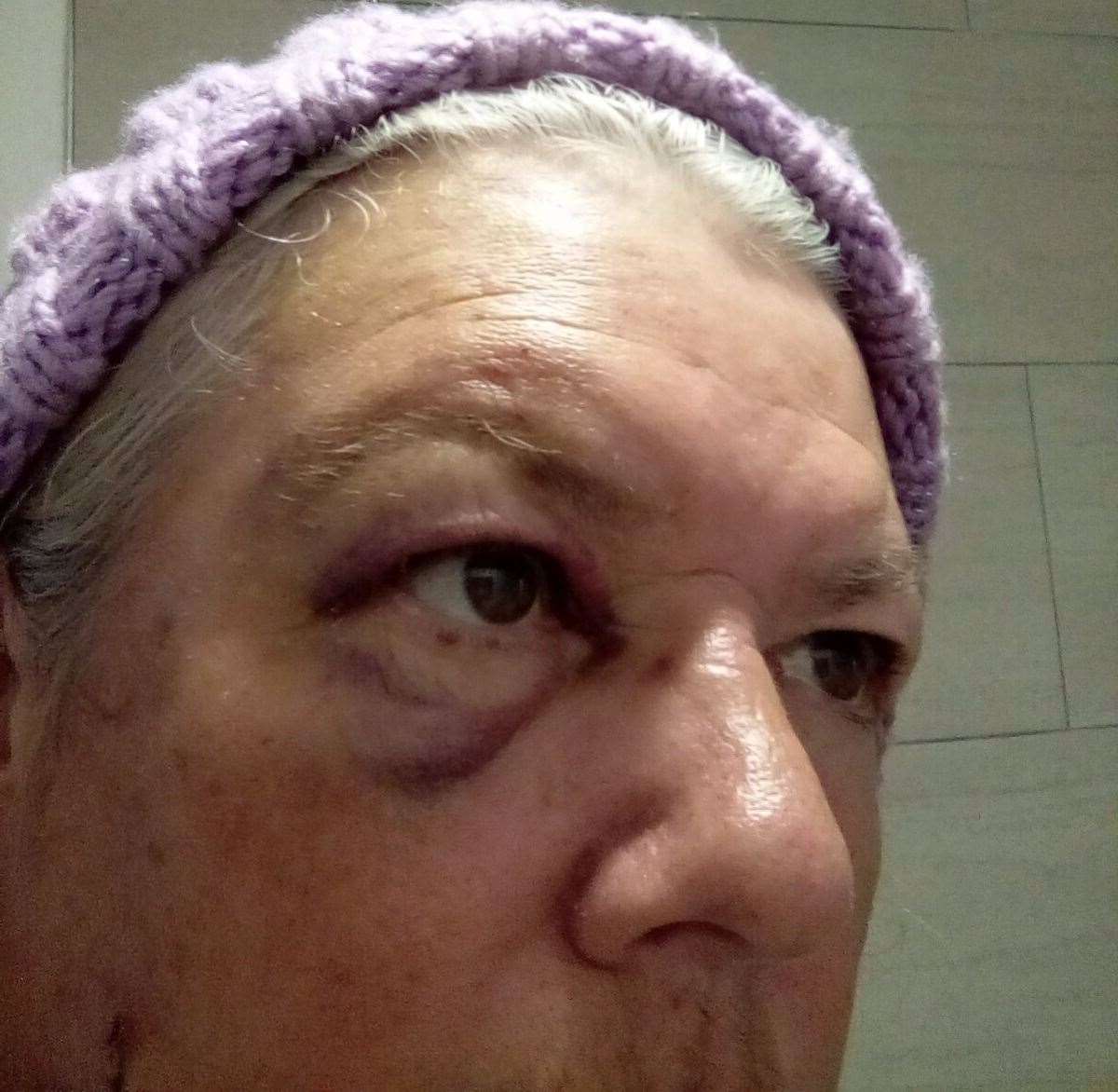 Karen Walker was left with a black eye and a cut to the cheek. Picture: Karen Walker