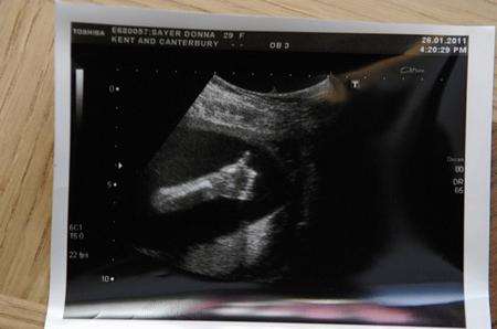 The scan of Donna Sayer's unborn baby show it giving the thumbs up!